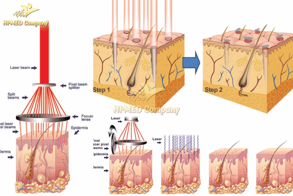 Minh họa cơ chế điều trị trẻ hóa da bằng laser phân đoạn tác động lên các lớp biểu bì và hạ bì